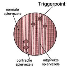 triggerpoint